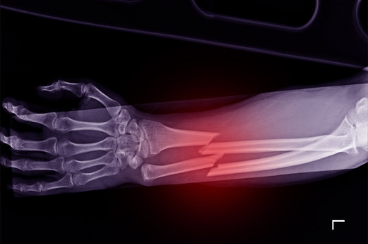 Fractures-------12