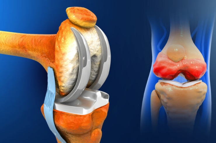 Joint reconstruction------12