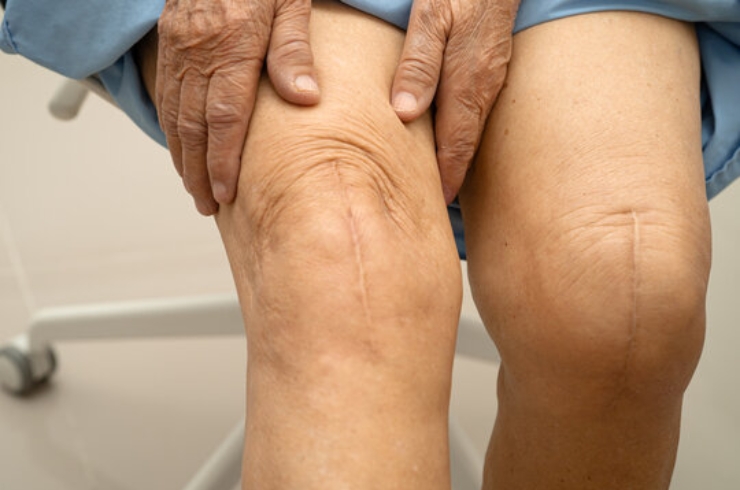 Knee Replacement------12